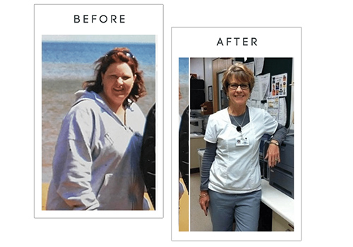 before-and-after-bariatric-surgery-3