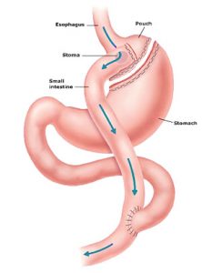 types gastric bypass surgery
